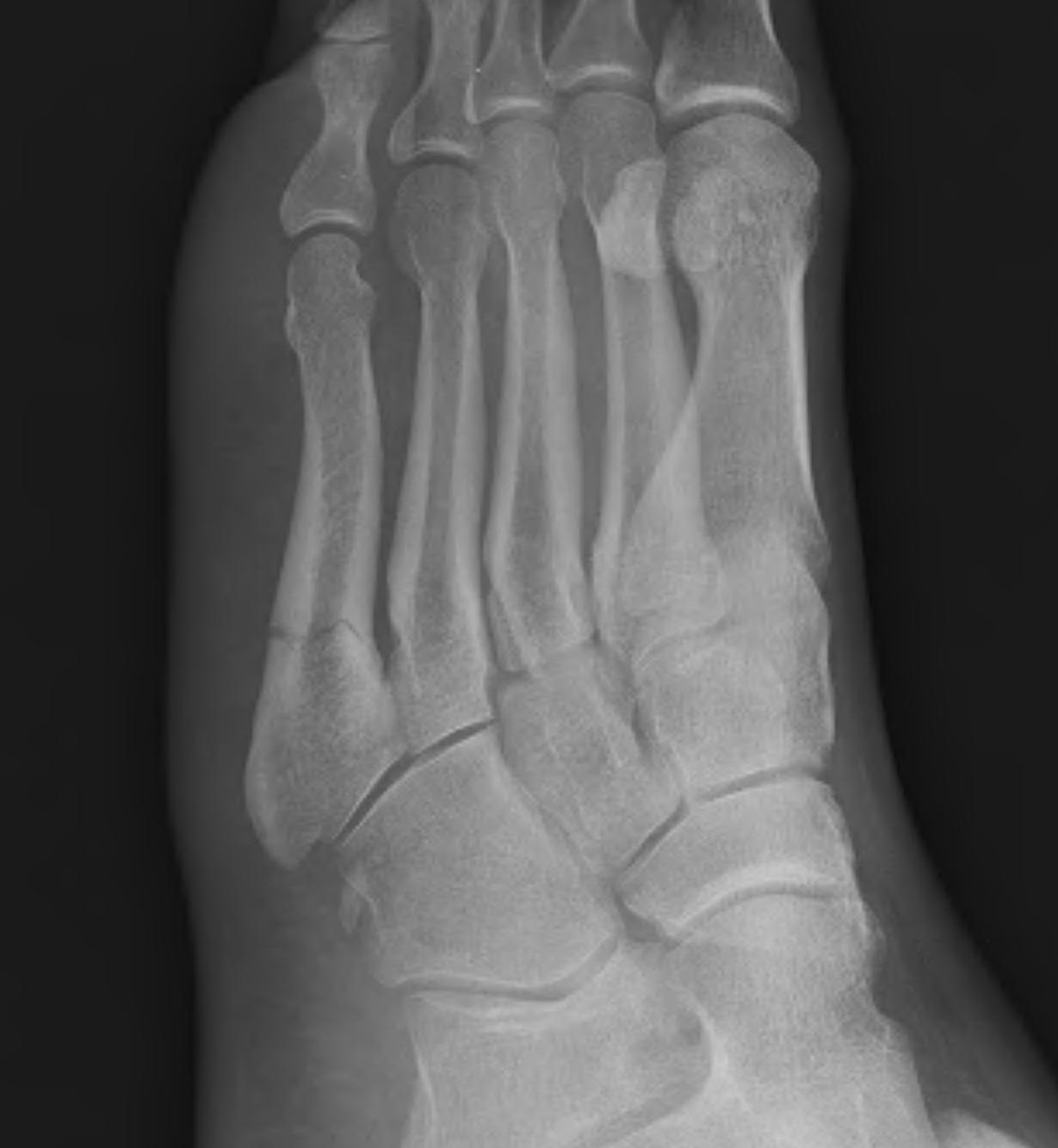 Base of 5th Metatarsal Fracture Zone 2